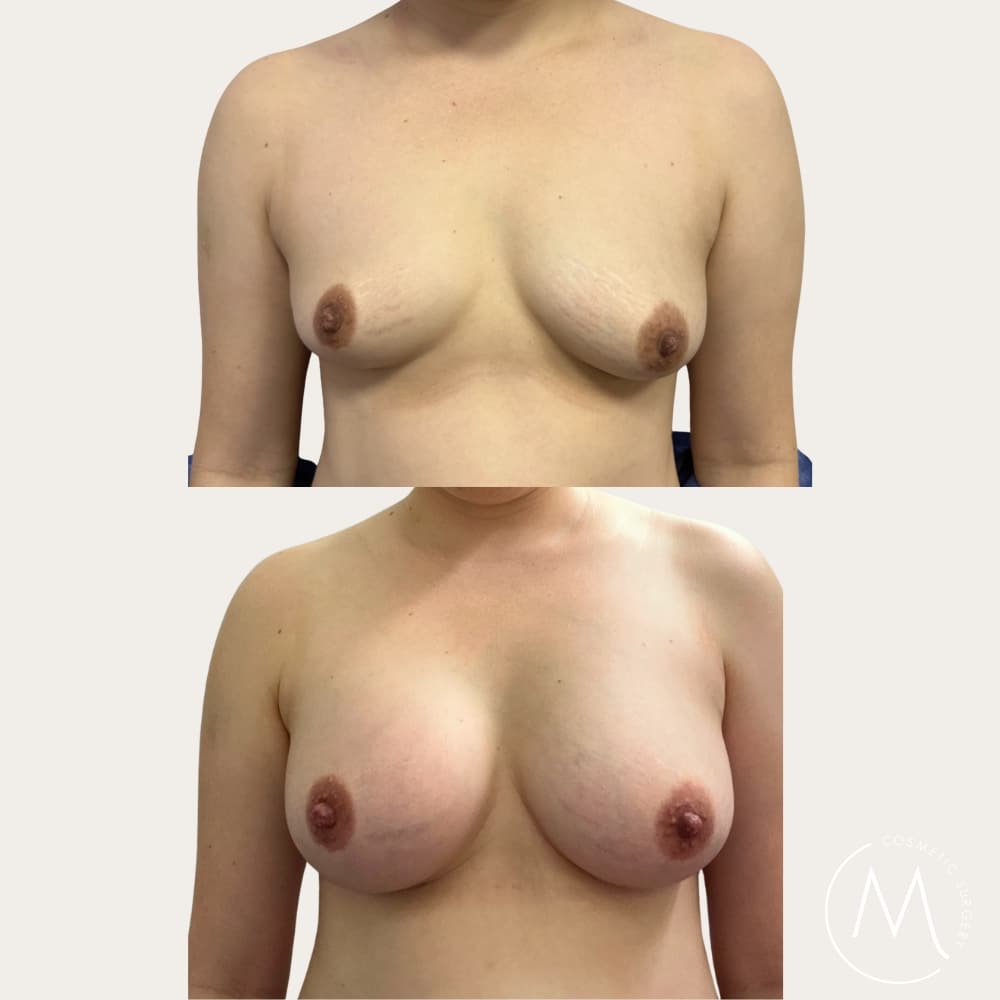 Before and after picture of breast augmentation patient
