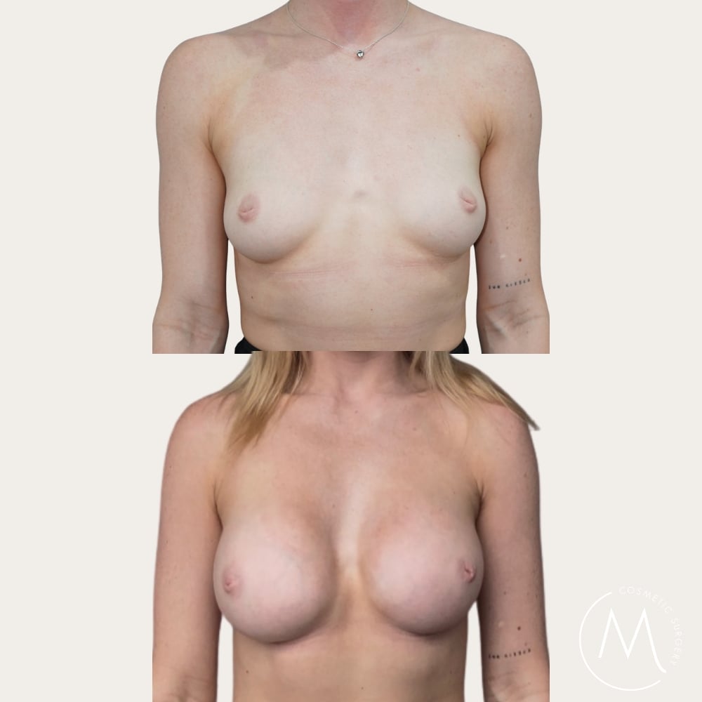 Before and after picture of breast augmentation patient