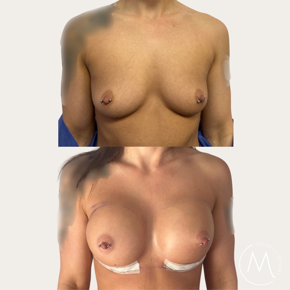 Before and after picture of breast augmentation patient