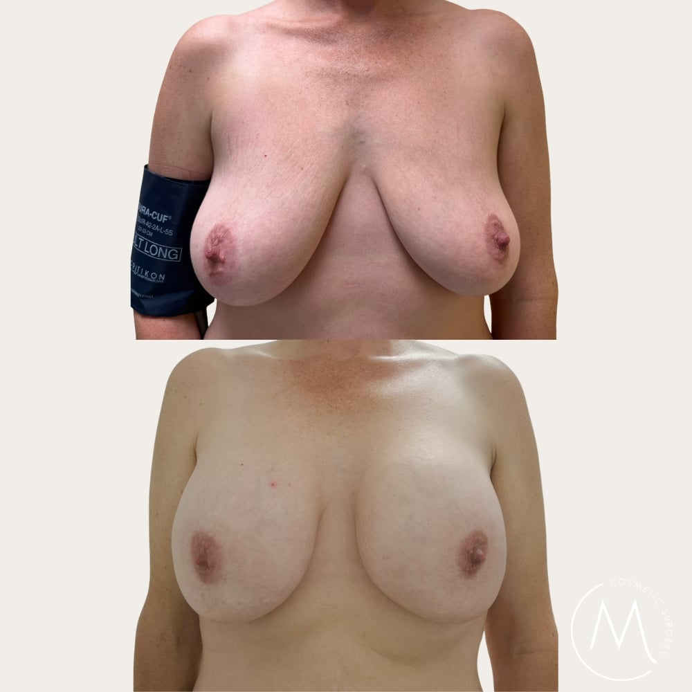 Before and after picture of breast augmentation patient