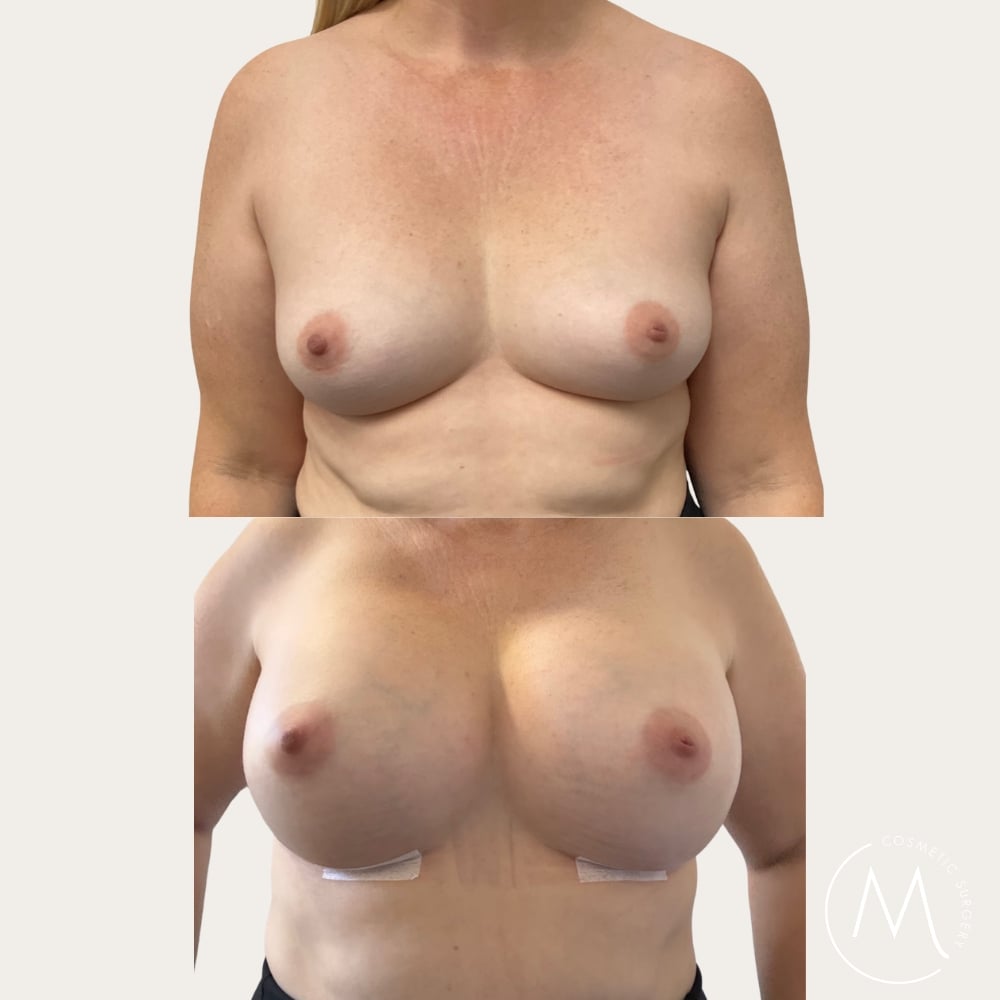 Before and after picture of breast augmentation patient
