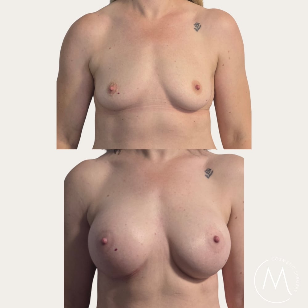 Before and after picture of breast augmentation patient