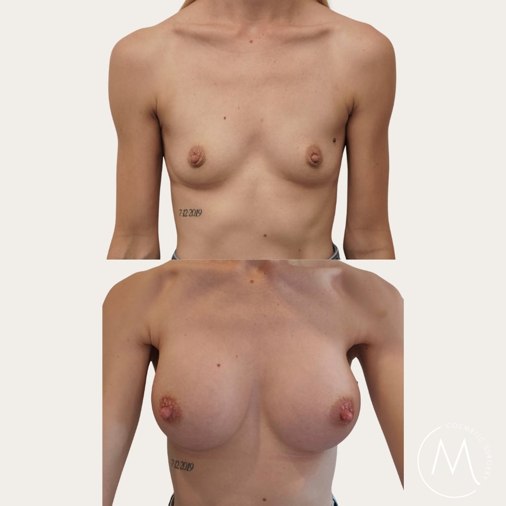 Before and after picture of breast augmentation patient