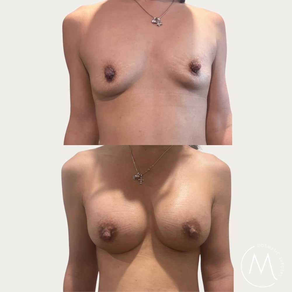 Before and after picture of breast augmentation patient