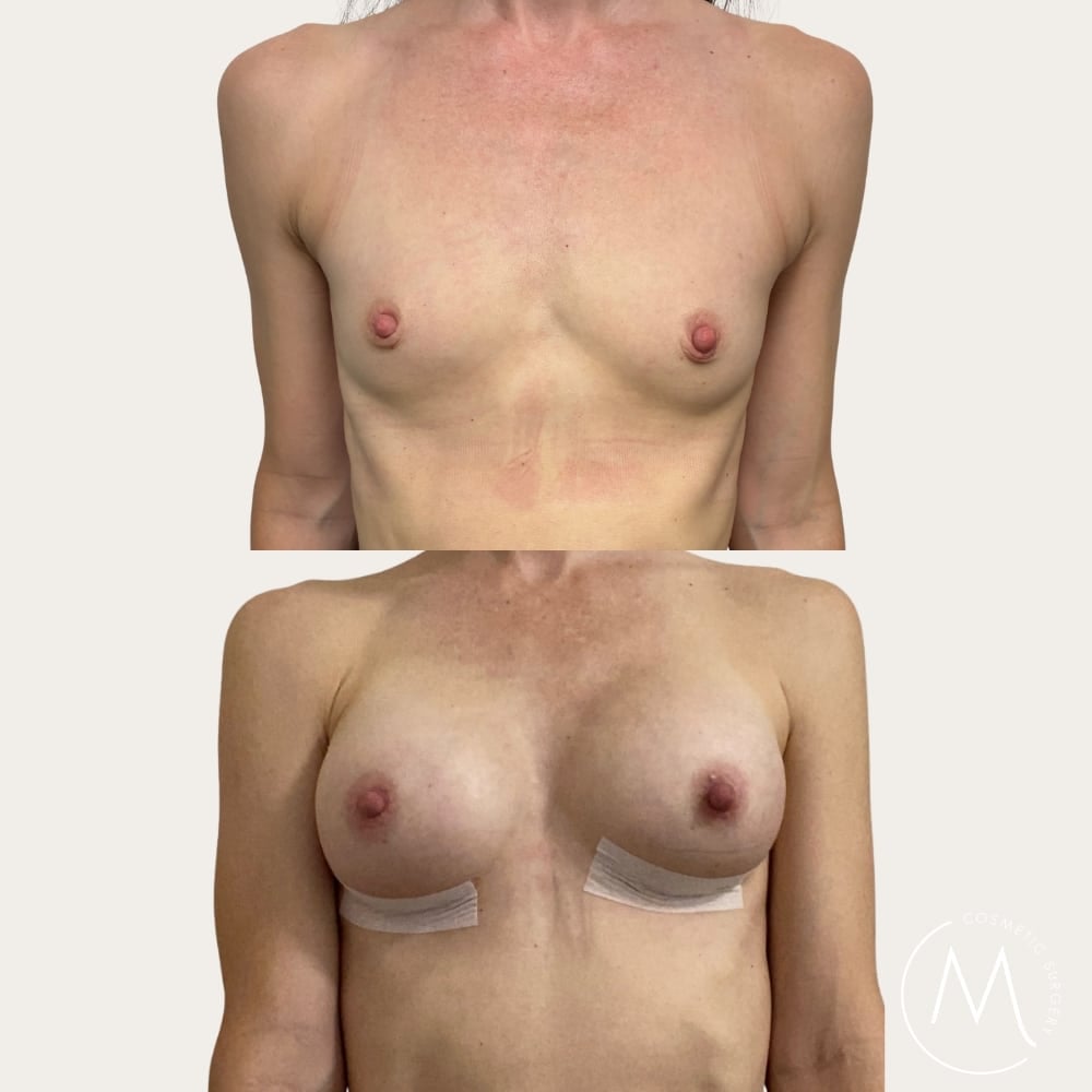 Before and after picture of breast augmentation patient