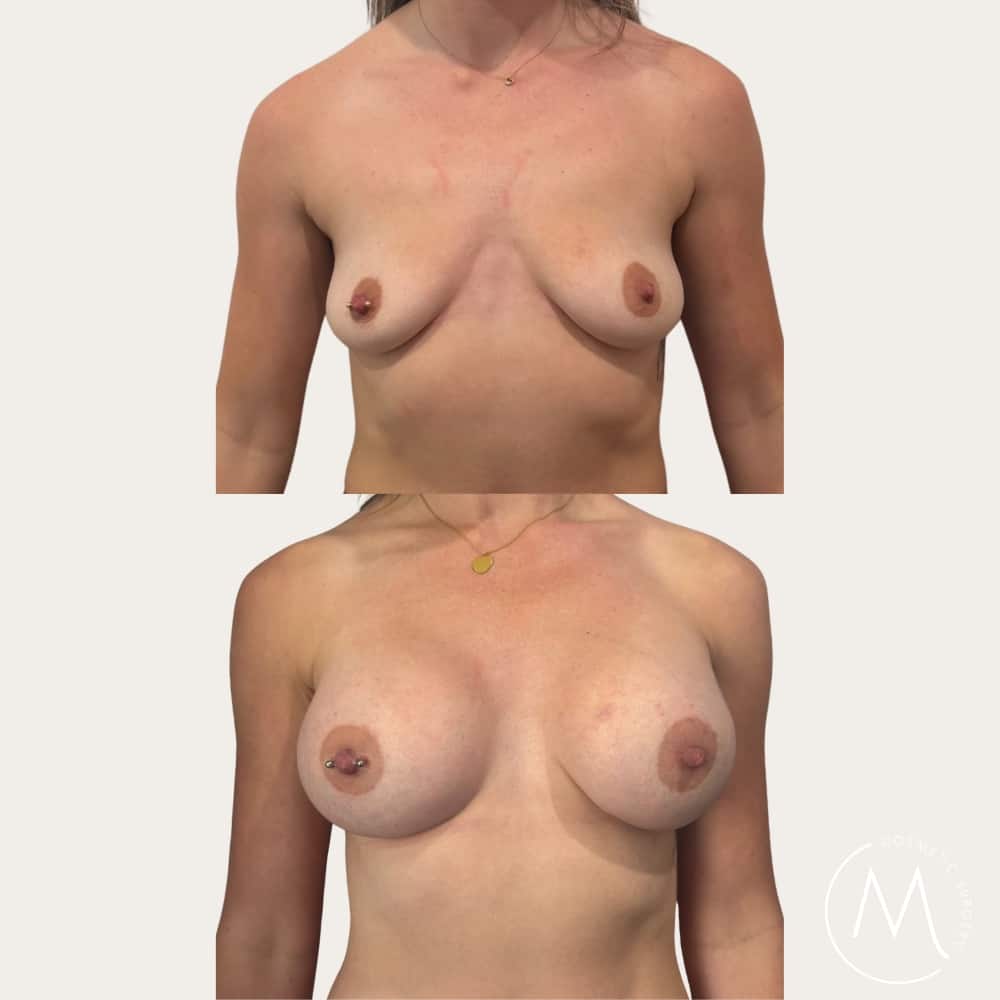 Before and after picture of breast augmentation patient