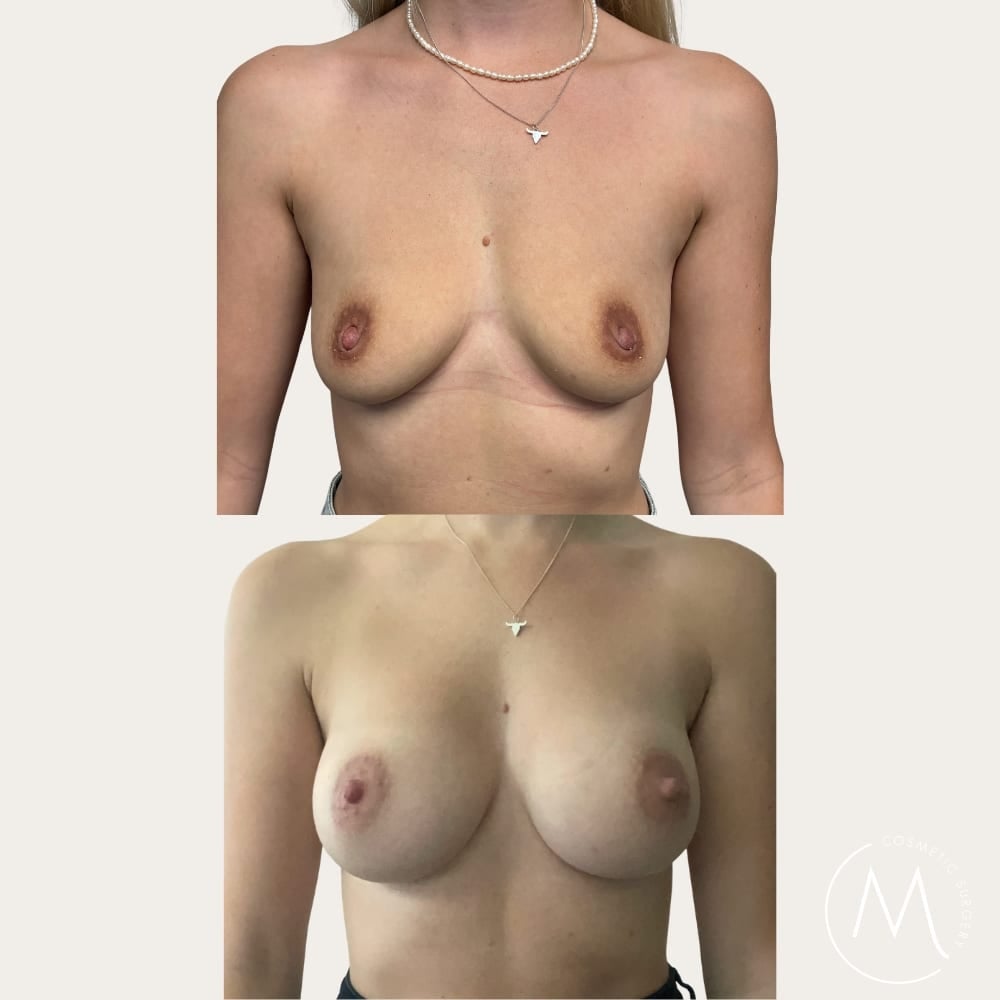 Before and after picture of breast augmentation patient