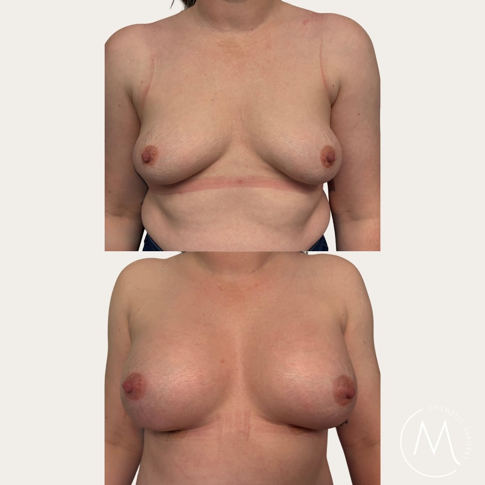 Before and after picture of breast augmentation patient